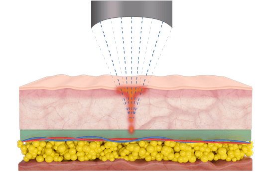 Microson HIFU by MEDILIFE — image 3