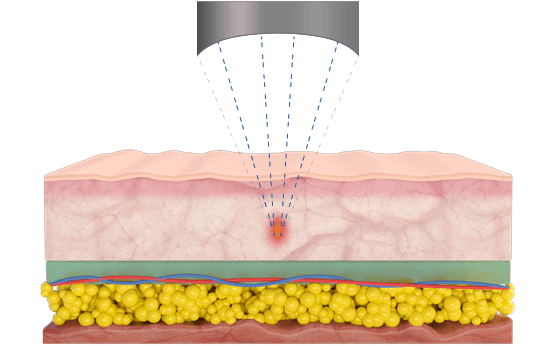 Microson HIFU by MEDILIFE — image 4