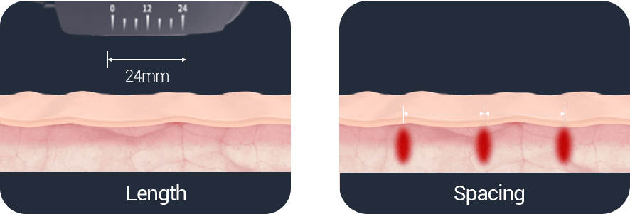 Microson HIFU by MEDILIFE — image 5