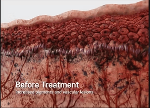 Sylfirm X RF Microneedling by MEDILIFE — image 5