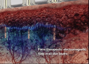 Sylfirm X RF Microneedling by MEDILIFE — image 6