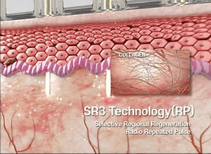 Sylfirm X RF Microneedling by MEDILIFE — image 7