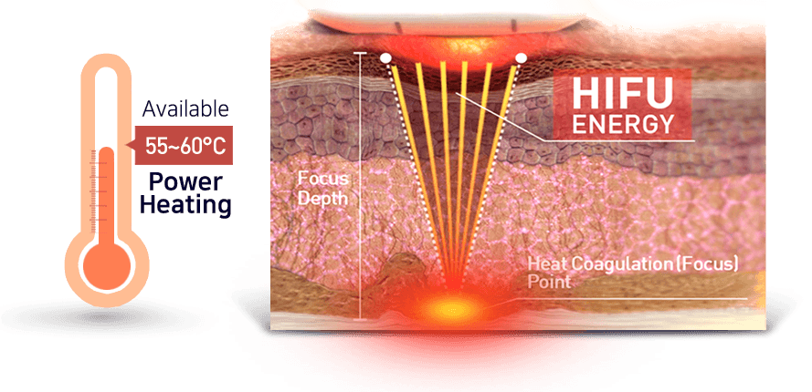 Ultra Vera — Vaginal Rejuvenation HIFU by MEDILIFE — image 2