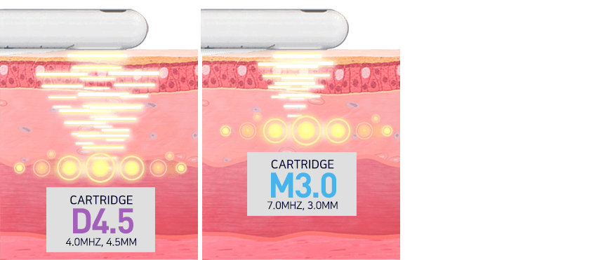 Ultra Vera — Vaginal Rejuvenation HIFU by MEDILIFE — image 6